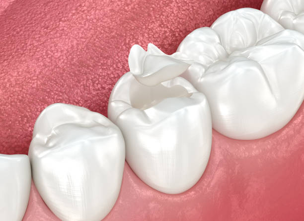 Best Dental Inlays and Onlays  in Ponchatou, LA