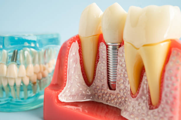 Best Dental Fillings (Composite and Amalgam)  in Ponchatou, LA